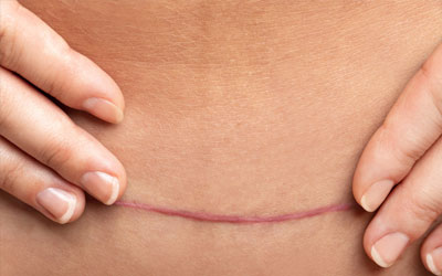 Understanding Your Scar: Healing, Sensation & What to Look Out For